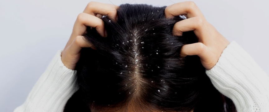 get rid of dandruff